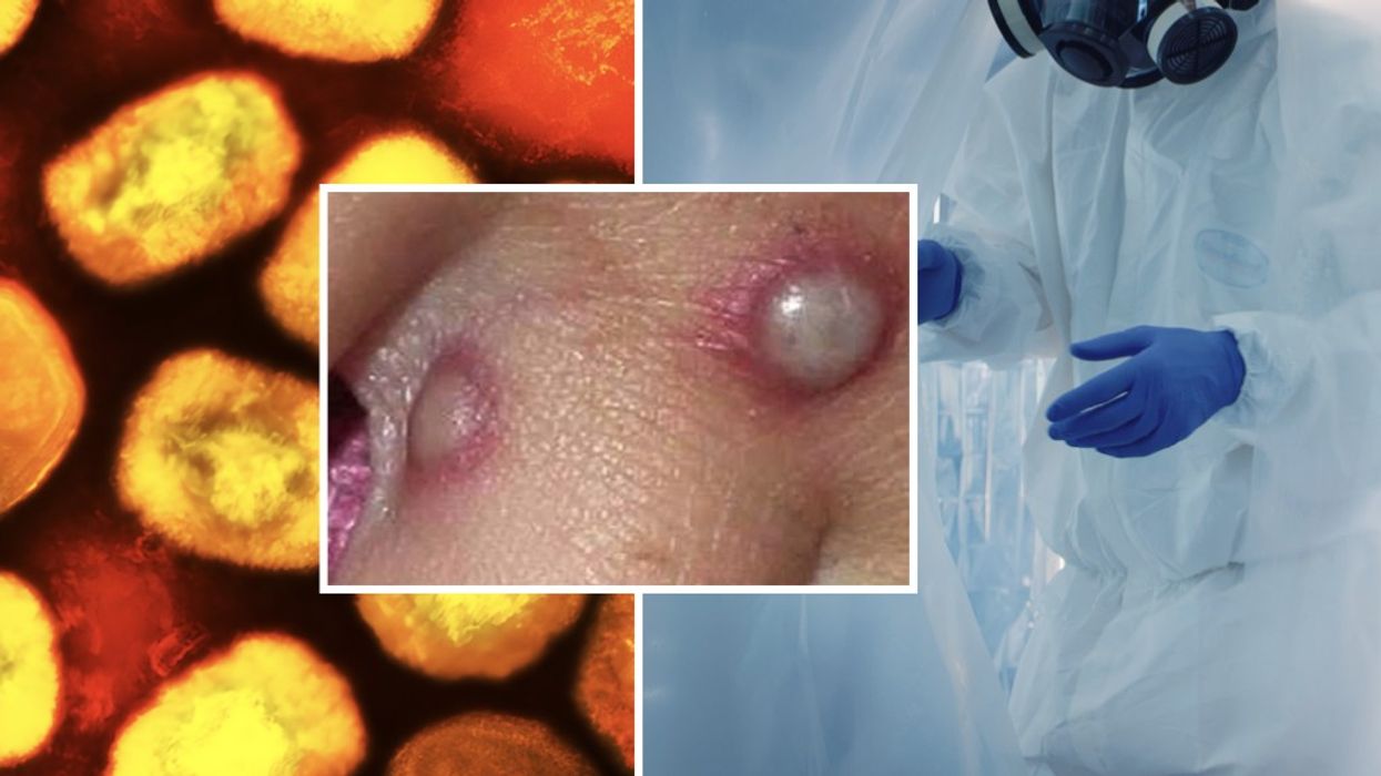 Composite image of monkeypox