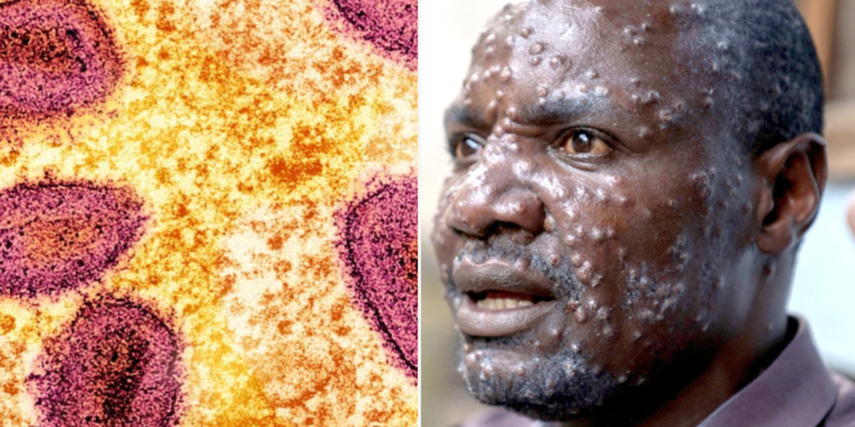 NextImg:Travel alert issued for Britons over mpox risk at popular African hotspot