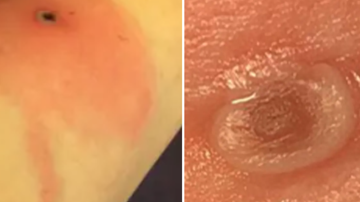 Composite images of lesions caused by Alaskapox