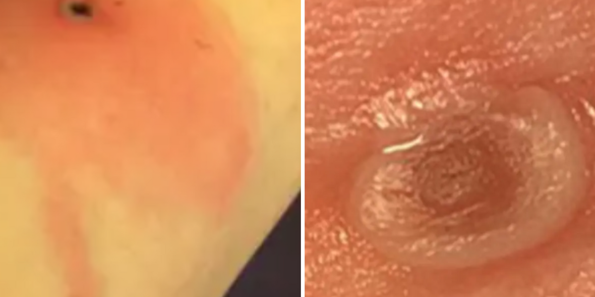 NextImg:Alaskapox breaks out in US as horror images of the new viral disease emerge
