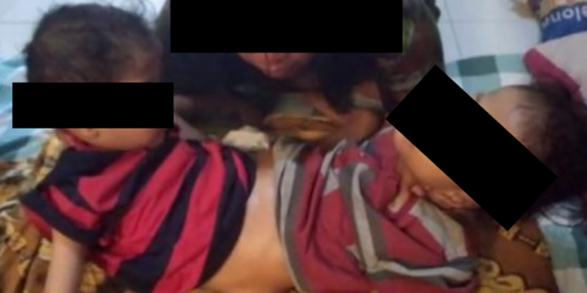 NextImg:Conjoined twins nicknamed the 'spider' have three legs, four arms and one penis in ultra rare phenomenon