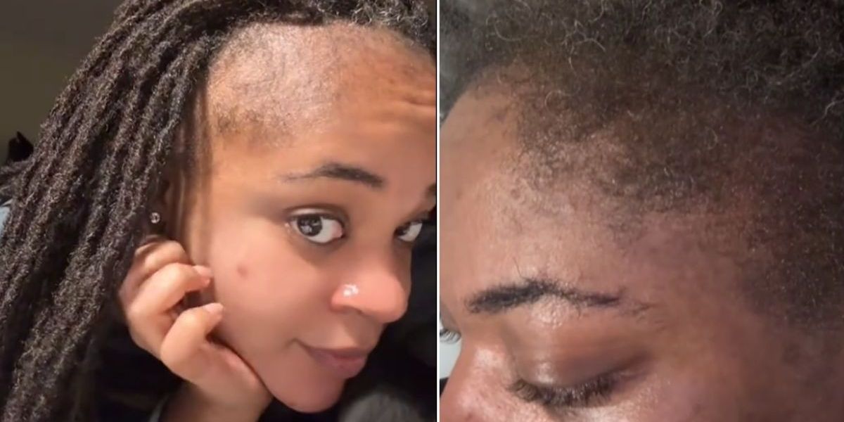 NextImg:Hair care: 'I filled in my hairline and reversed my bald patches with just one product applied twice a week'