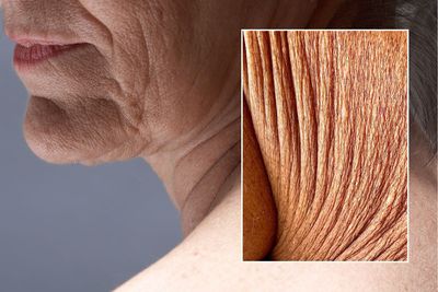 Crepey skin on older woman