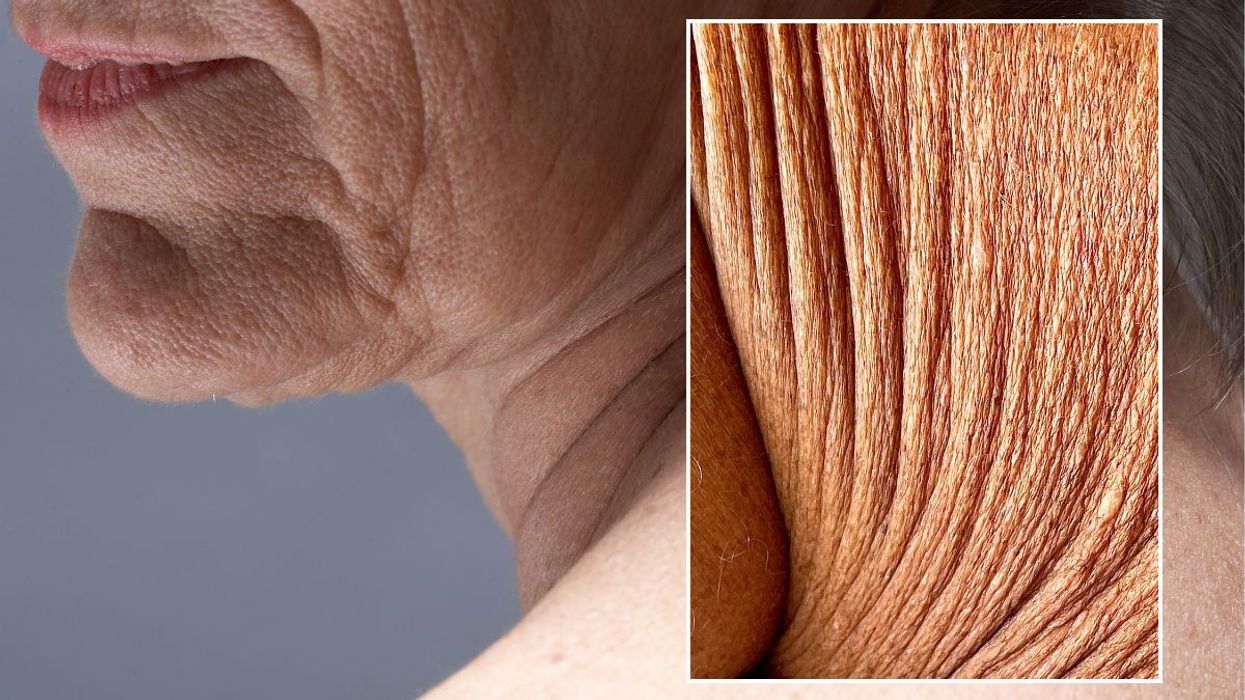 Crepey skin on older woman