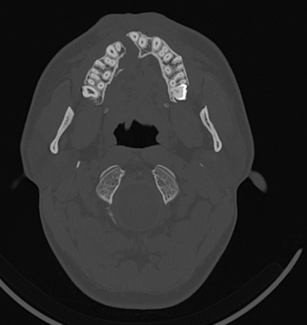 CT images