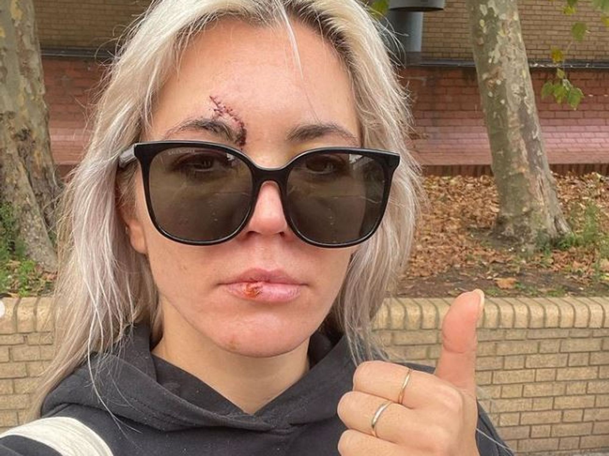 Danni Menzies face injury