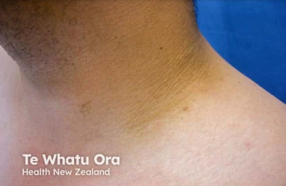 Darker skin around neck