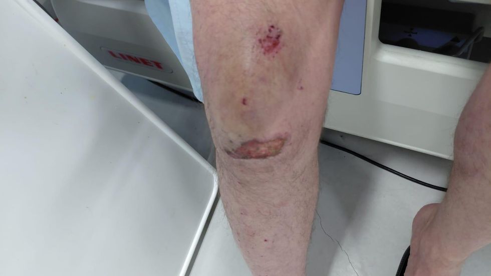 David Mason's cut knee