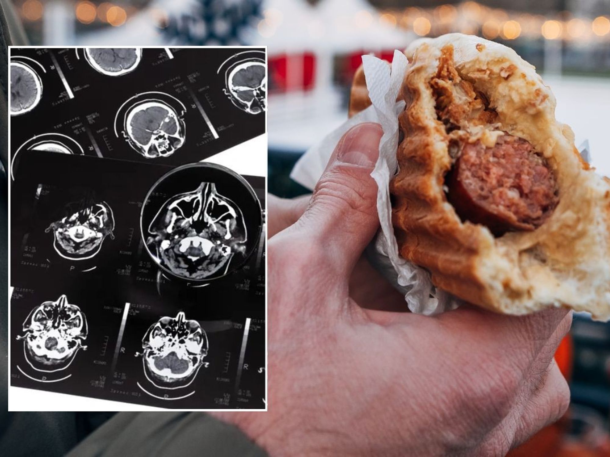 dementia brain scan and processed meat