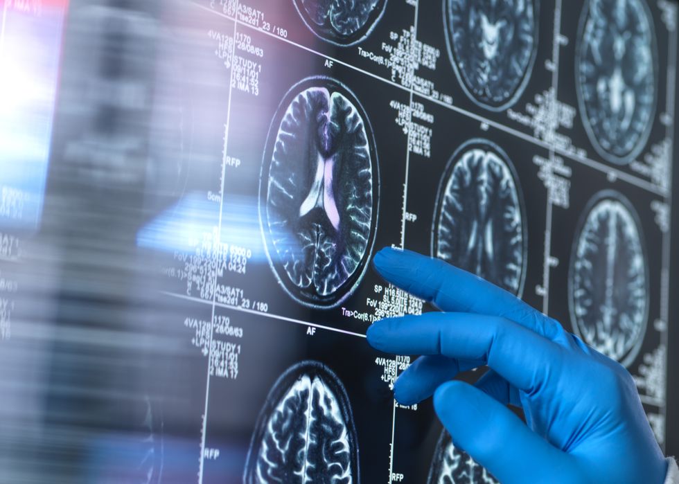 Dementia brain scan