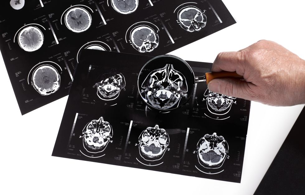 DEMENTIA BRAIN SCAN