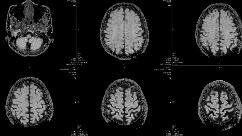 DEMENTIA SCAN