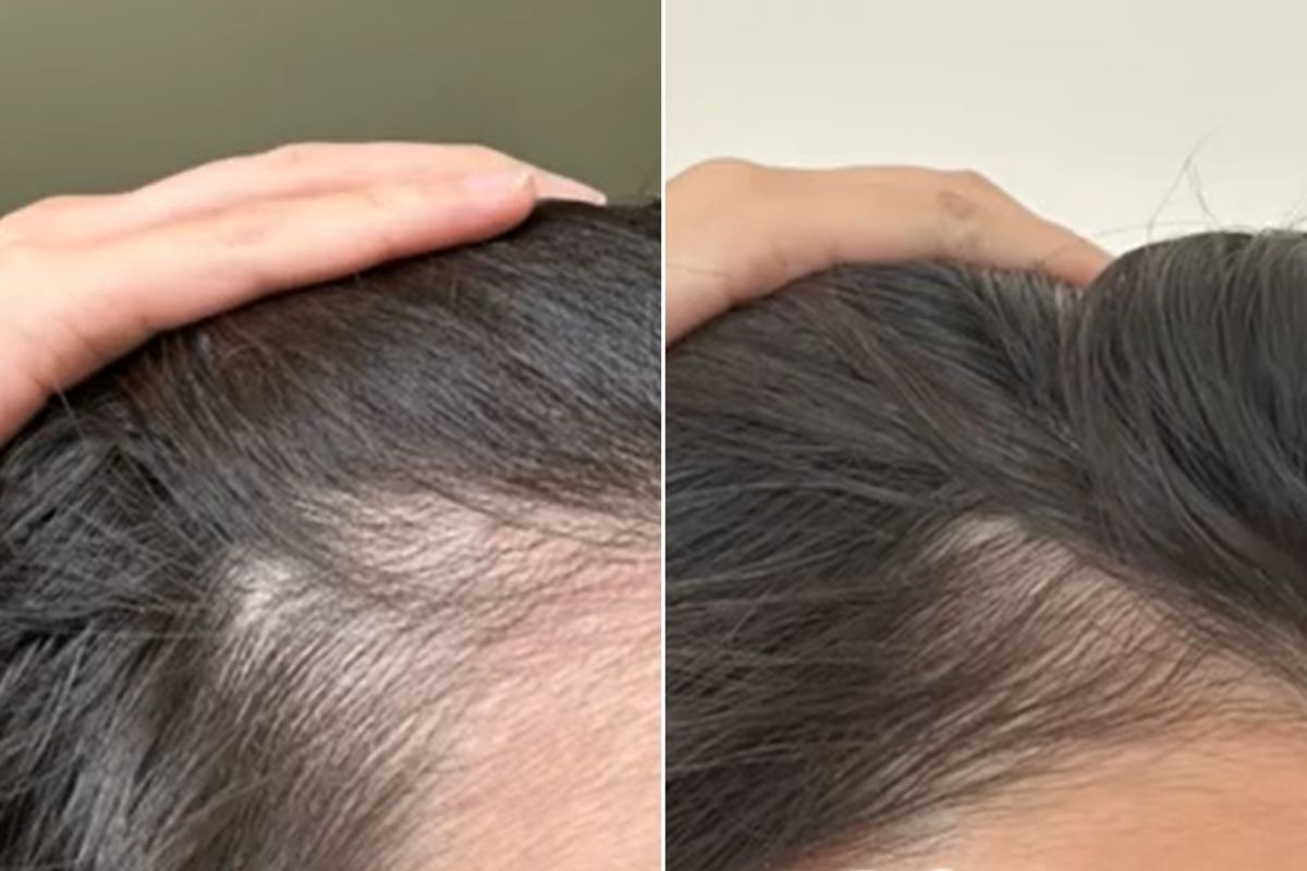 Dermatologist hair before and after