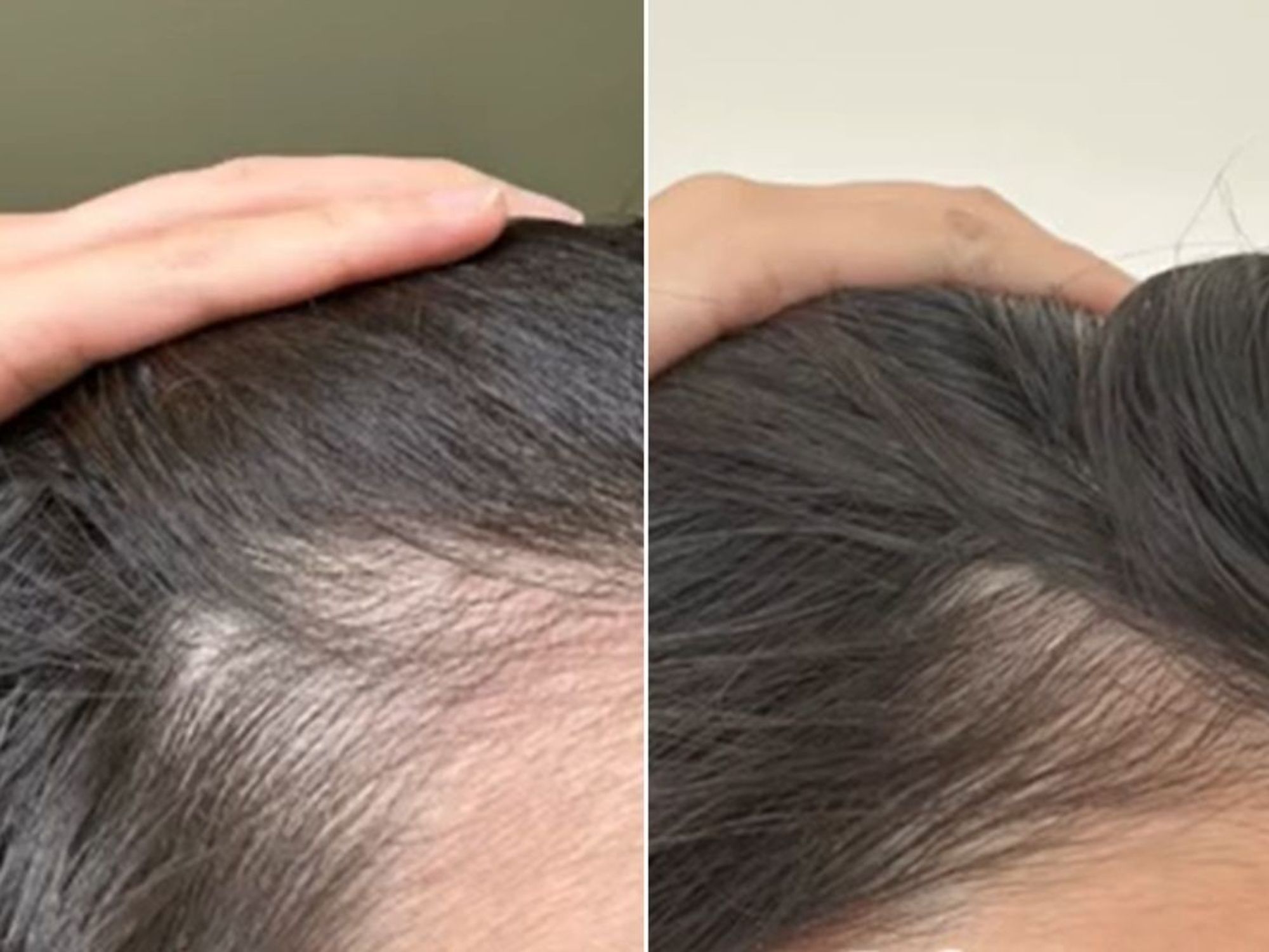 Dermatologist hair before and after