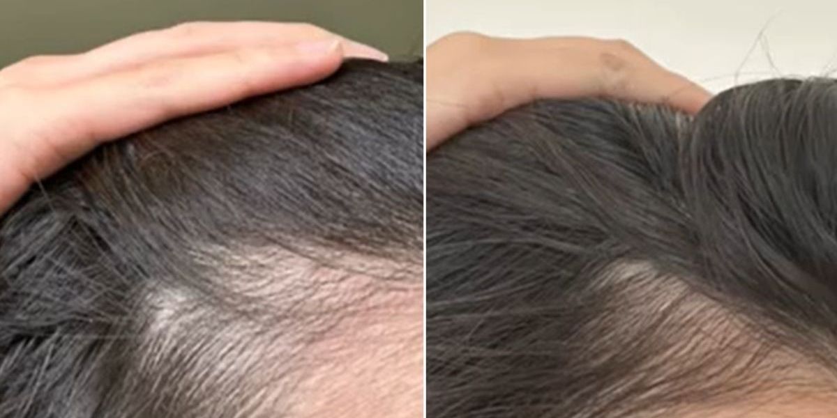 Dermatologist swears by 4 ‘hair growth essentials’ that reverse bald patches thicken the hairline Dermatologist swears by 4 ‘hair growth essentials’ that reverse bald patches thicken the hairline