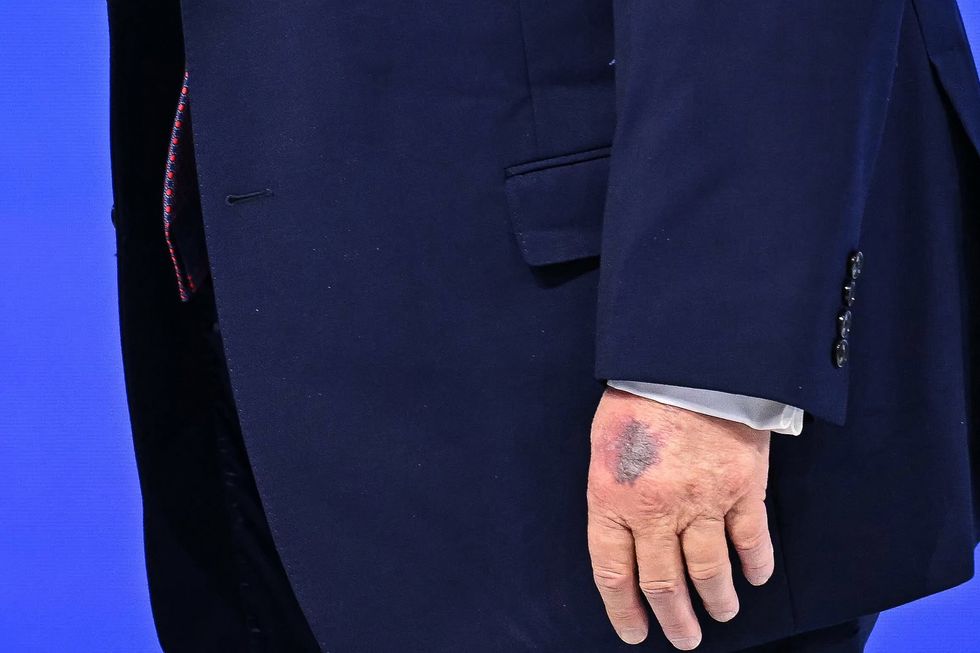 Donald Trump hand bruise
