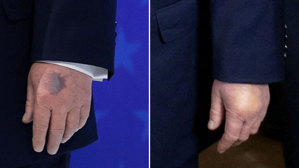 Donald Trump hand bruising