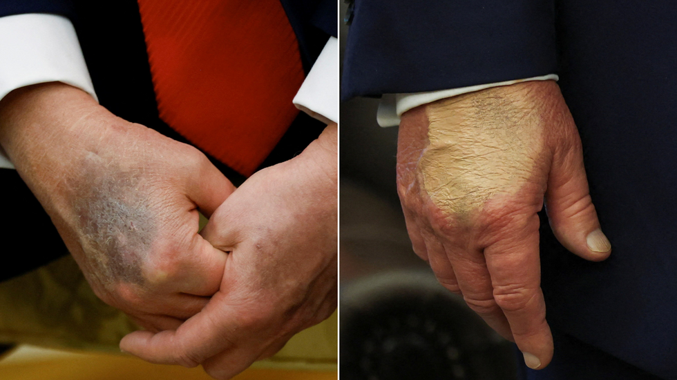 Ruce Donalda Trumpa