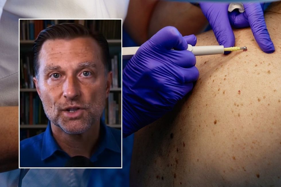 DR BERG AND WART ON BACK