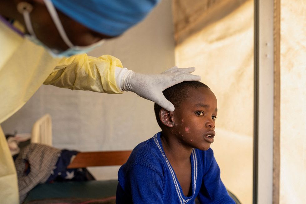 Dr Tresor Wakilongo, verifies the evolution of skin lesions on the ear of Innocent, suffering from Mpox\u200b