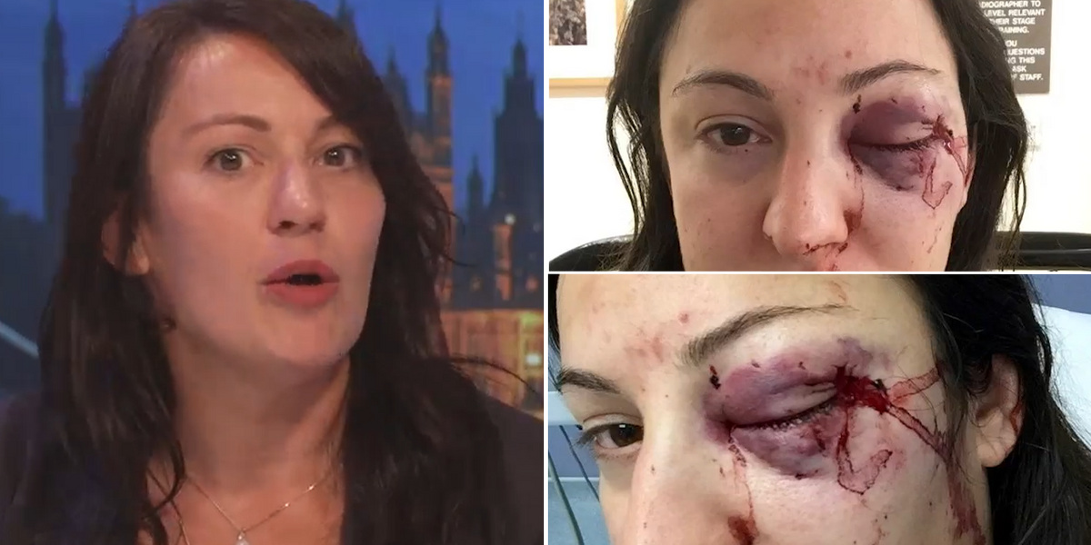 NextImg:Briton who suffered horror injuries after standing up to thieves 'was made to feel like a criminal’