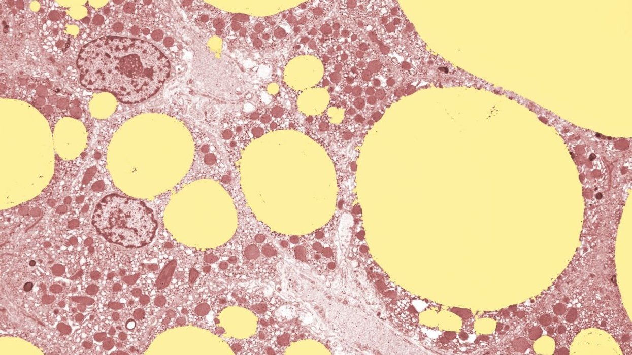 FAT CELLS IN THE LIVER