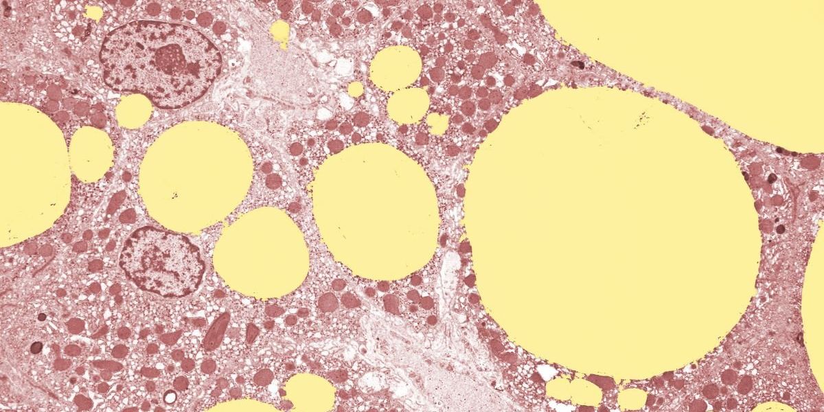 From kidney stones to fatty liver disease, the hidden dangers found lurking in bubble tea From kidney stones to fatty liver disease, the hidden dangers found lurking in bubble tea