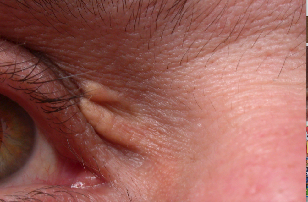 Fatty deposits of cholesterol around a person's eyes