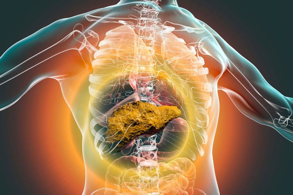 FATTY LIVER DISEASE composite