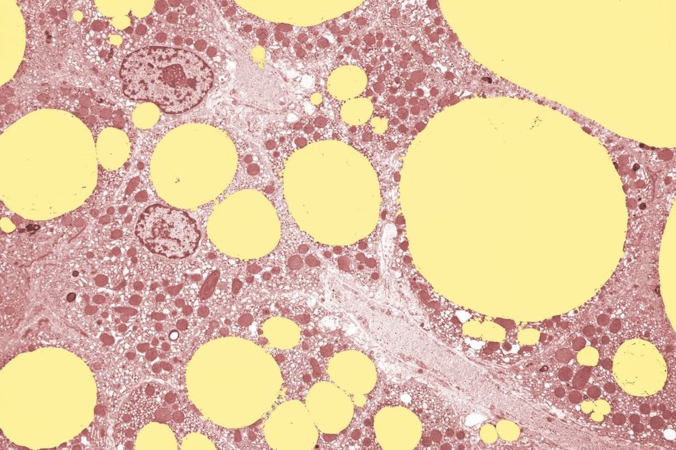 fatty liver under microscope