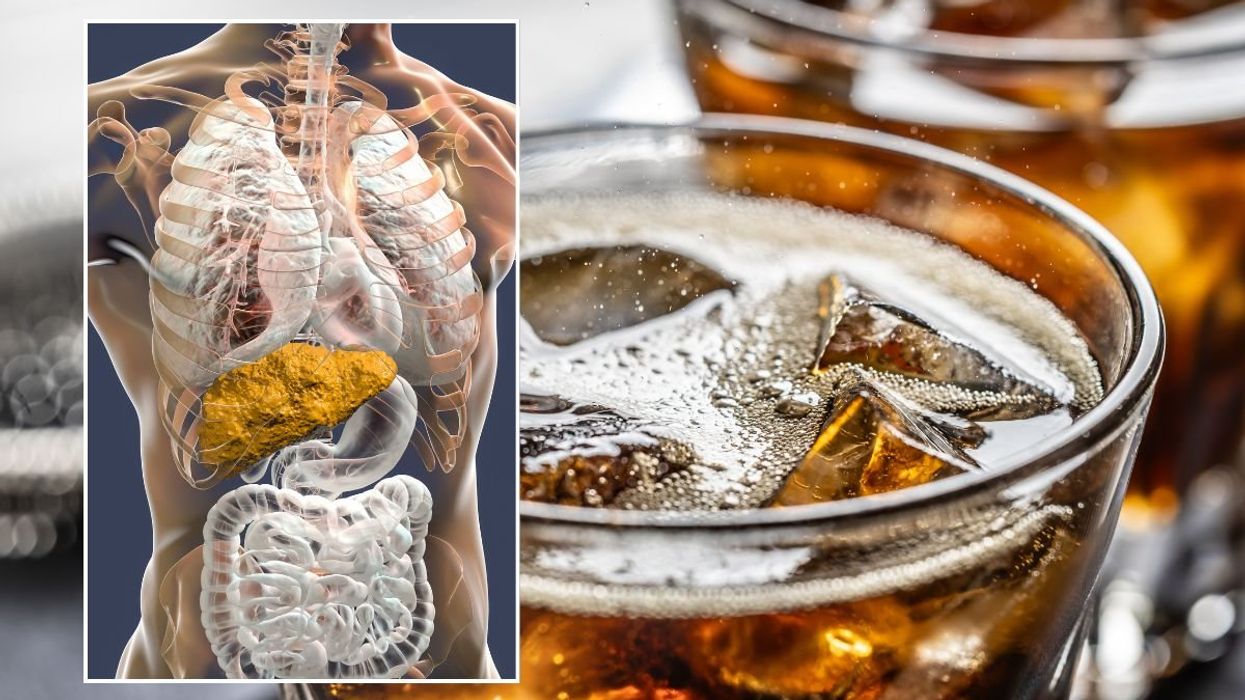 FIZZY DRINK AND FATTY LIVER ILLUSTRATION