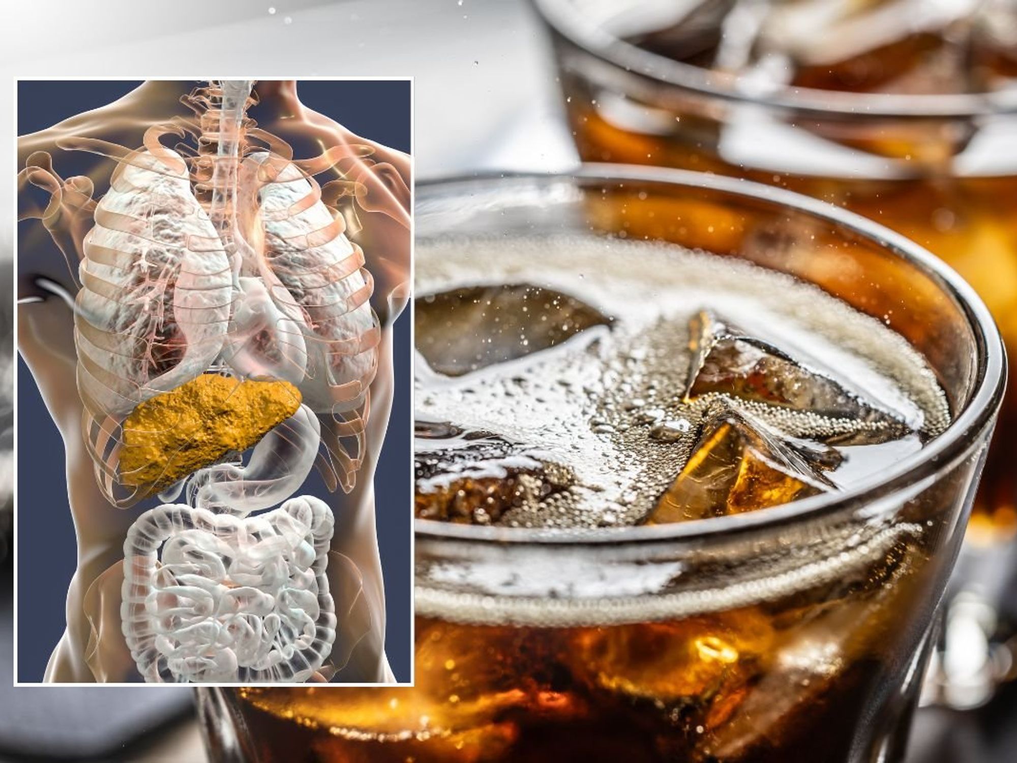 FIZZY DRINK AND FATTY LIVER ILLUSTRATION
