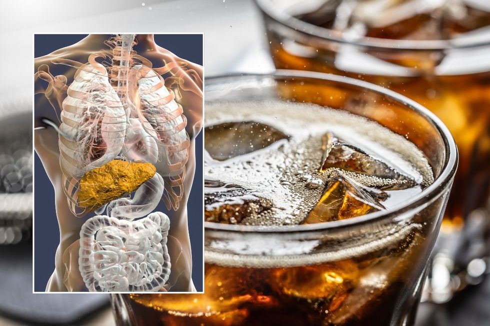 FIZZY DRINK AND FATTY LIVER ILLUSTRATION