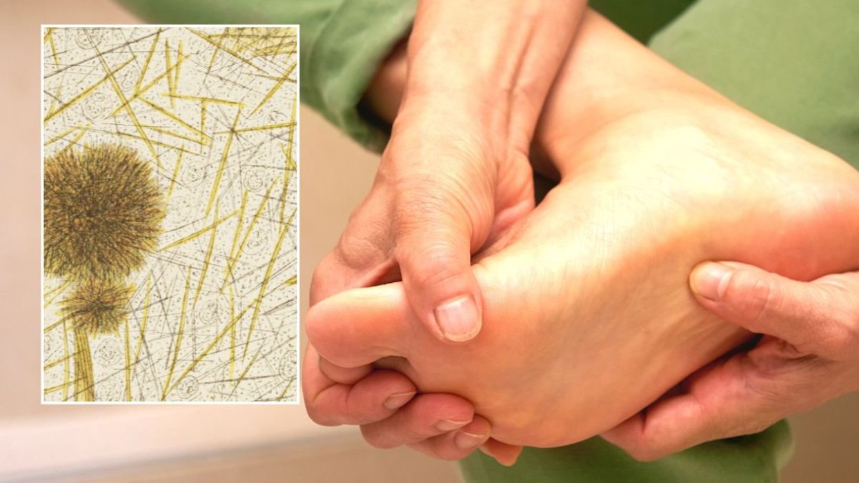 FOOT PAIN AND MICRSCOPE GOUT