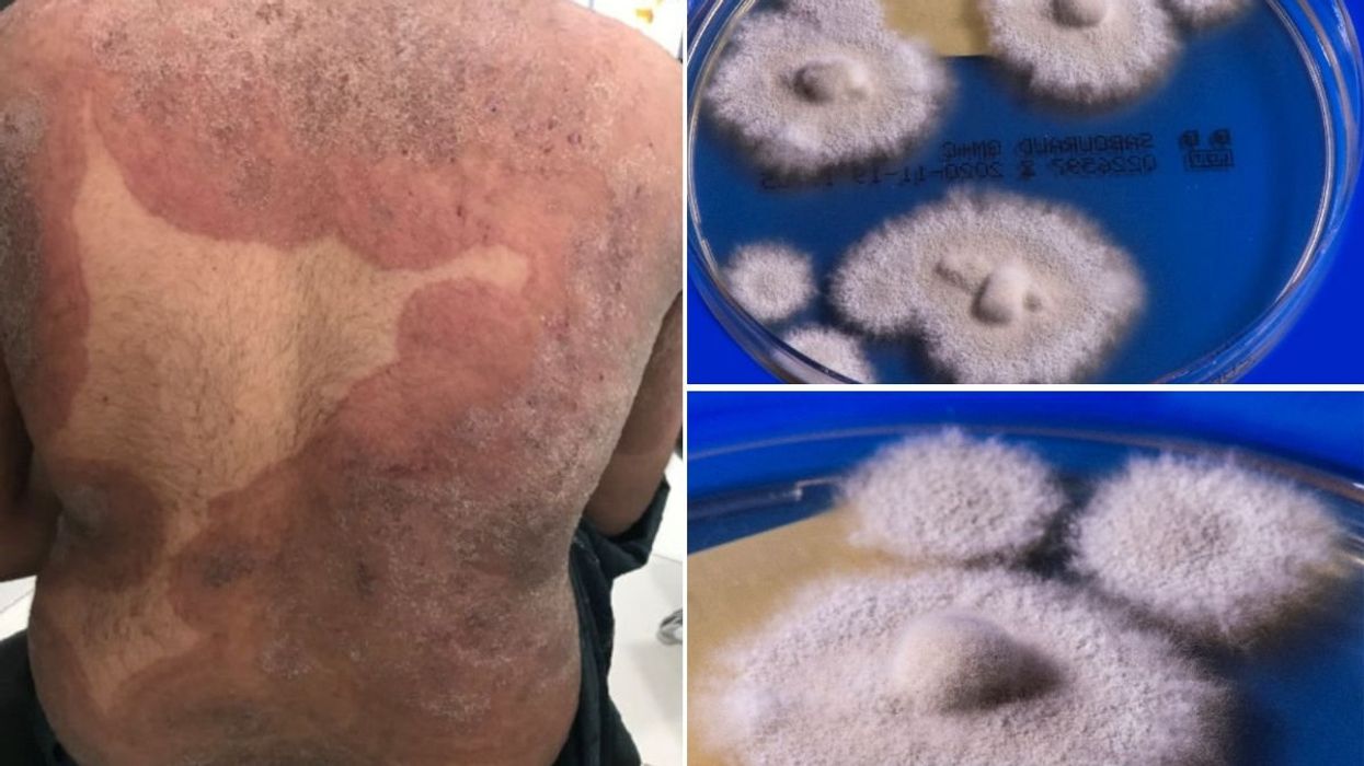 fungus in petri dish and man with rash