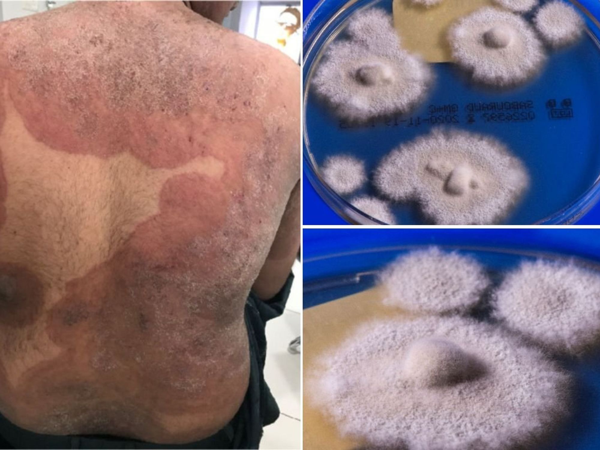 fungus in petri dish and man with rash