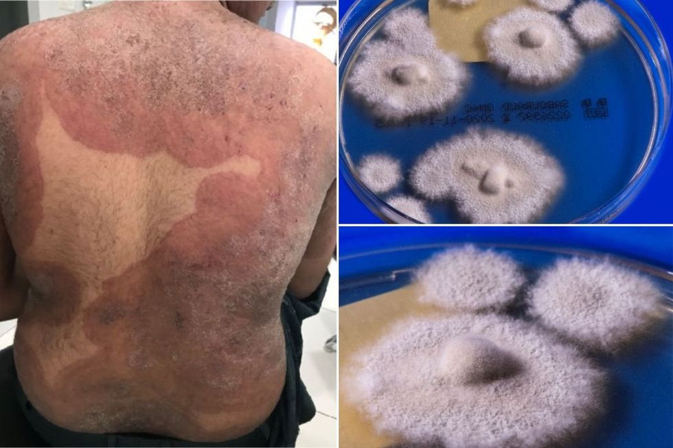 fungus in petri dish and man with rash