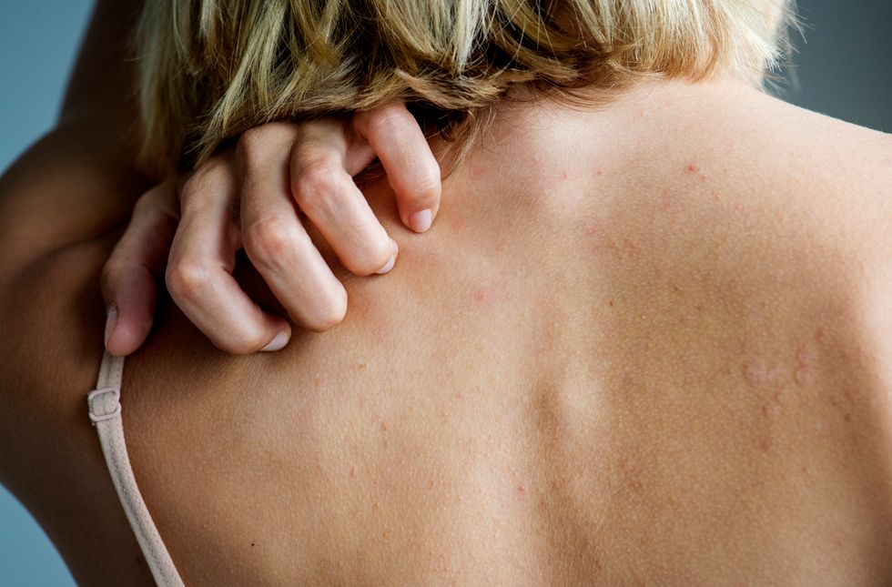Generic photo of a woman scratching a rash on her back. See PA Feature HEALTH Rashes. Picture credit should read: iStock/PA. WARNING: This picture must only be used to accompany PA Feature HEALTH Rashes