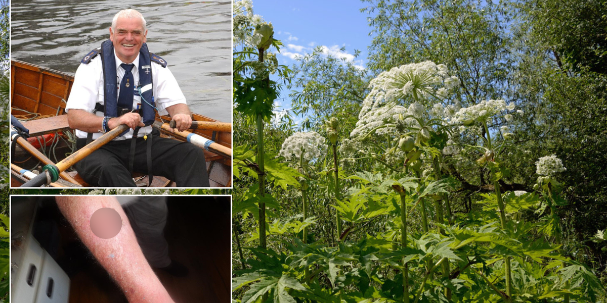 NextImg:Giant hogweed: Pensioner still in pain 50 years after exposure to 'Britain's most dangerous plant' as old wound breaks into gruesome sore