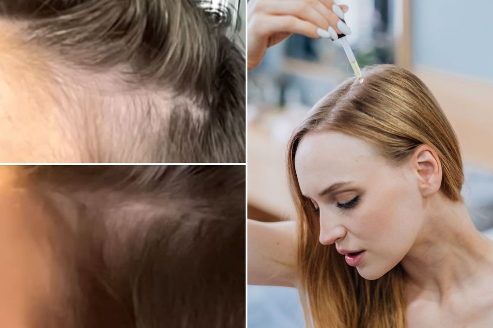 Hair before and after Nioxin