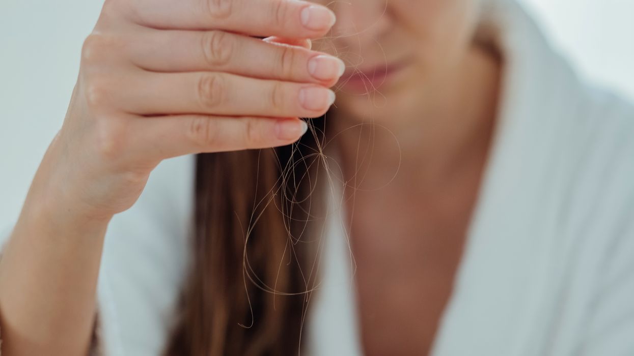 HAIR LOSS AND VITAMIN D STOCK