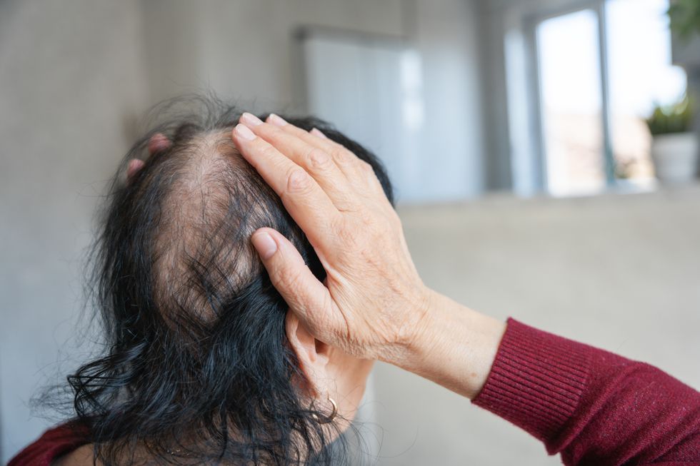 HAIR LOSS WOMAN