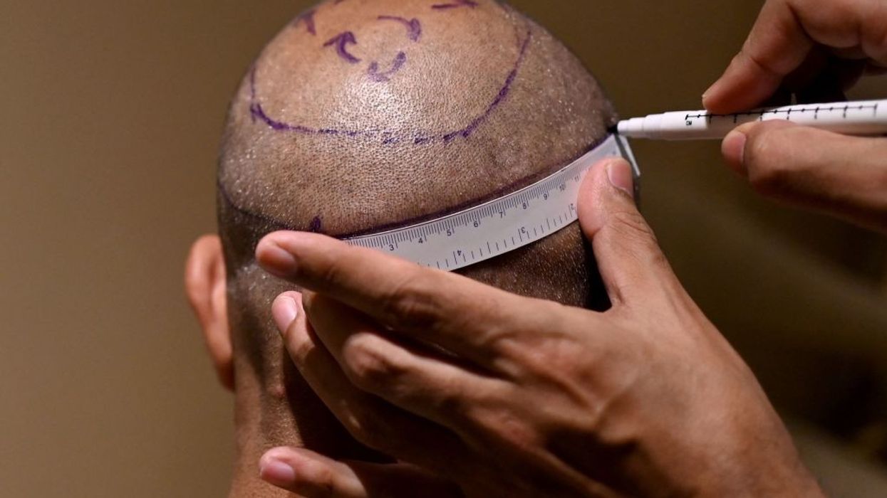 Hair transplant procedure