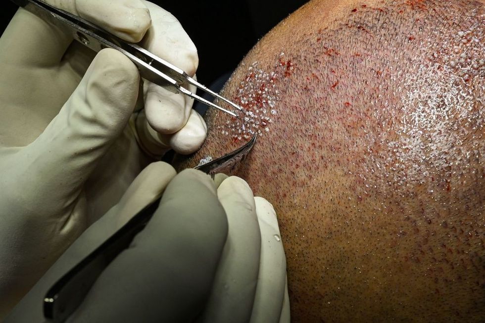 Hair transplant procedure