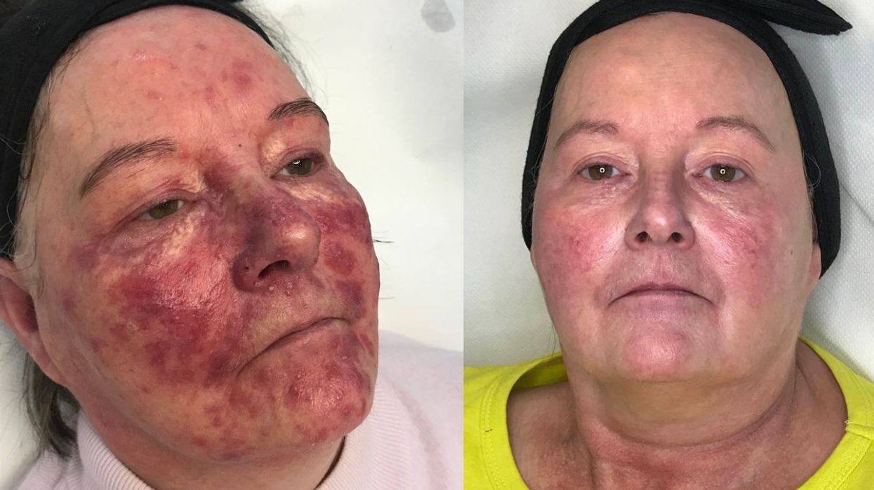 hazel rosacea skin