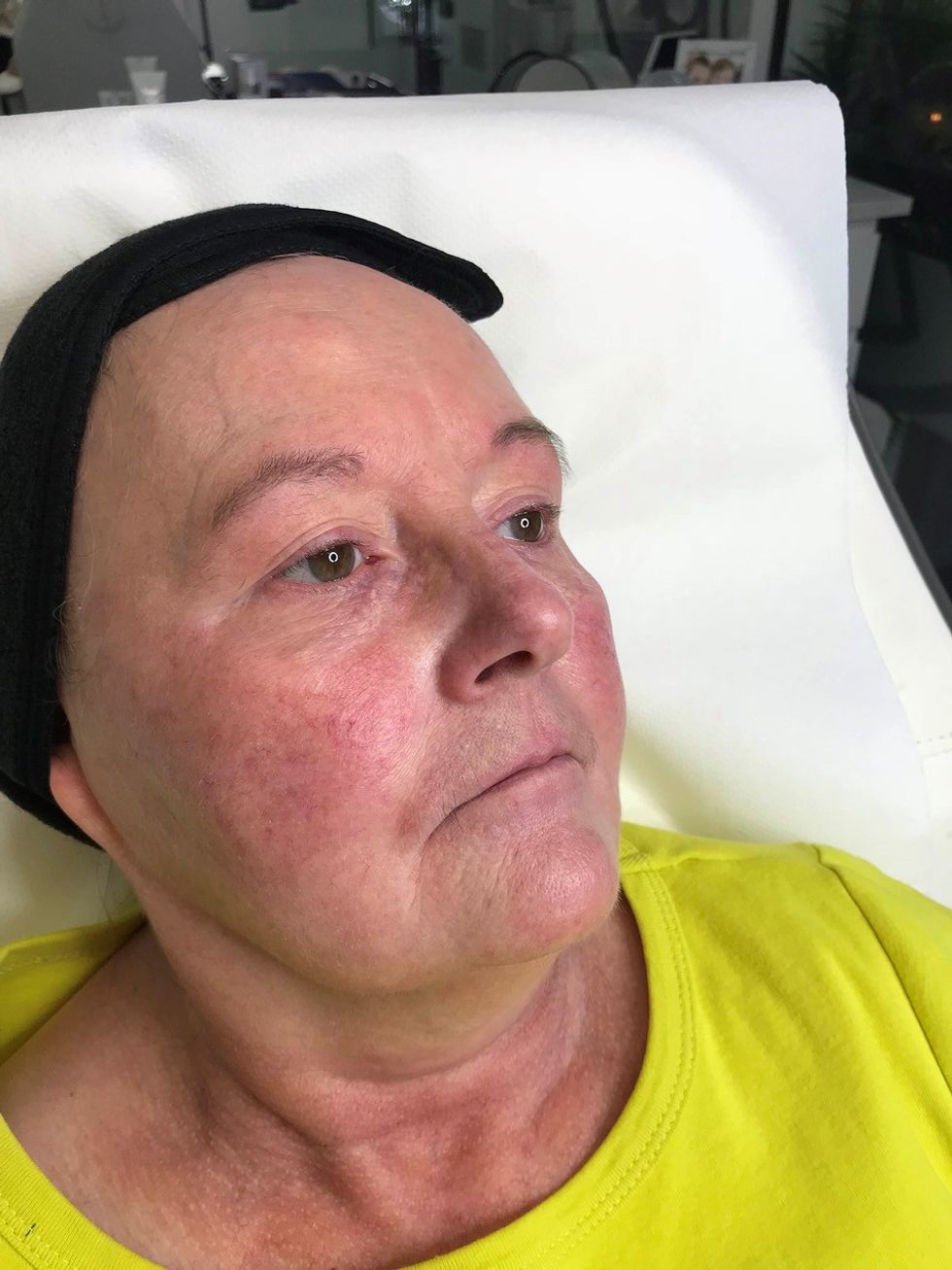 hazel rosacea skin