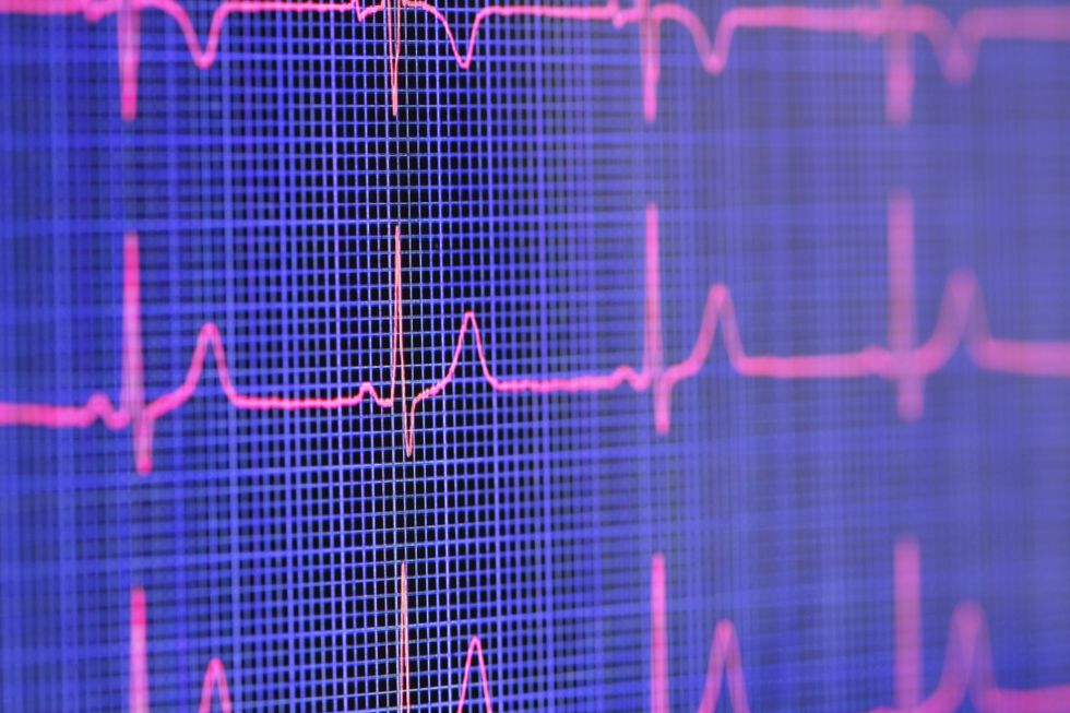 HEARTBEAT SHOWN ON ECG