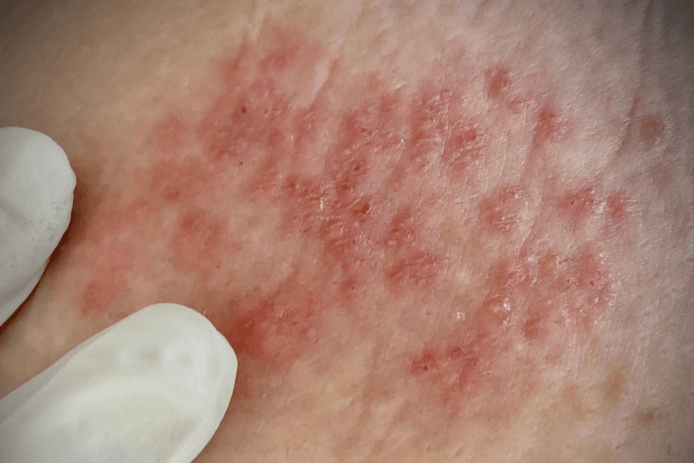 HERPES