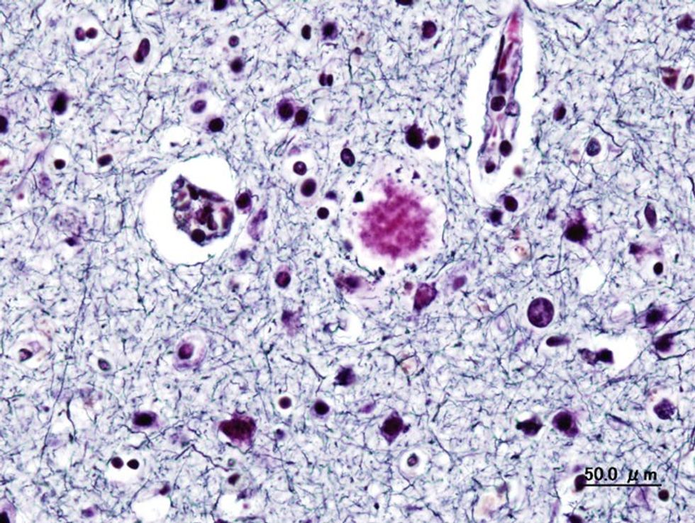Histopathogic image of senile plaques seen in the cerebral cortex in a patient with presenile onset of Alzheimer disease