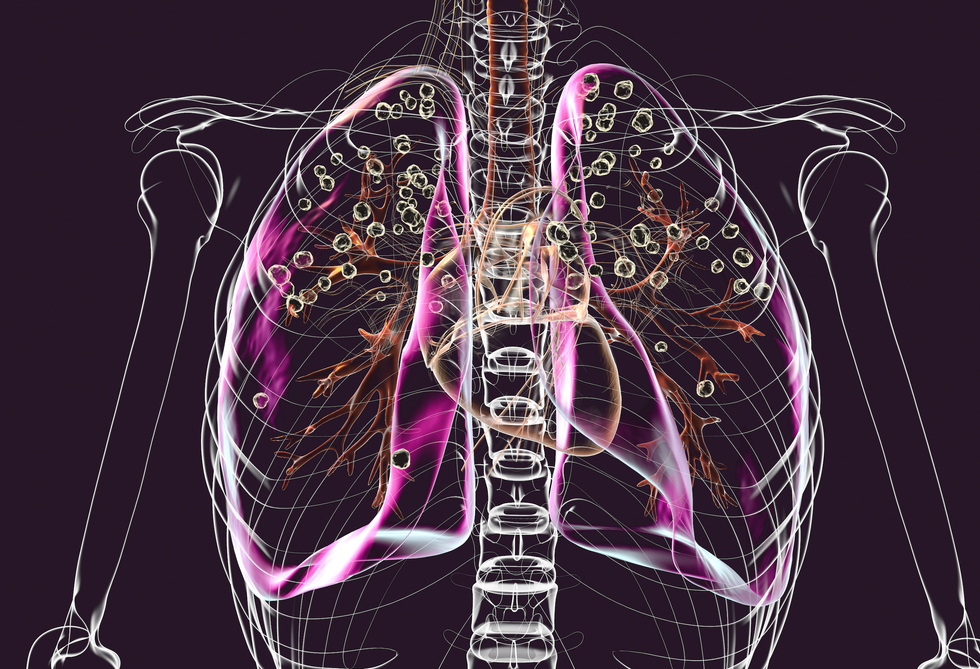 Illustration depicting lungs affected by silicosis within a transparent human body